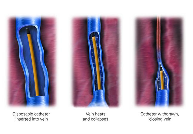 radio frequency, vascular, physicians, vein, treatment