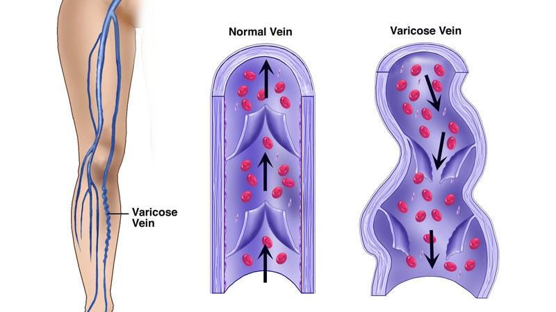 Causes and symptoms, vein treatment, varicose veins, Physician's Vascular Services Doctors